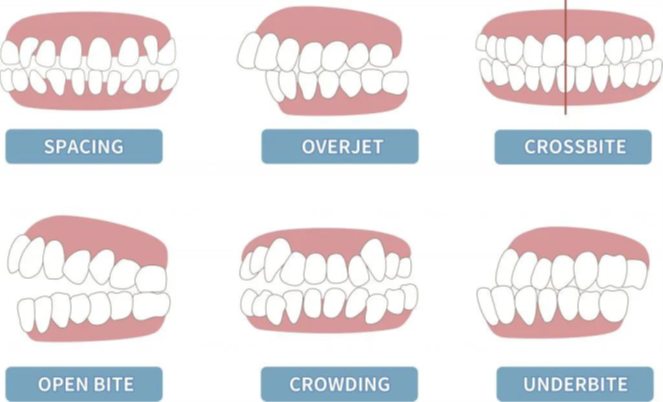 Braces Aurora CO Straighten Crooked Teeth Teeth Braces